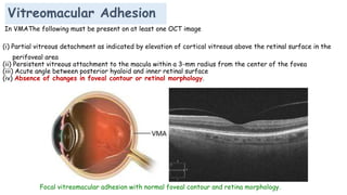 Vitreomacular Adhesion
In VMAThe following must be present on at least one OCT image
(i) Partial vitreous detachment as indicated by elevation of cortical vitreous above the retinal surface in the
perifoveal area
(ii) Persistent vitreous attachment to the macula within a 3-mm radius from the center of the fovea
(iii) Acute angle between posterior hyaloid and inner retinal surface
(iv) Absence of changes in foveal contour or retinal morphology.
Focal vitreomacular adhesion with normal foveal contour and retina morphology.
 