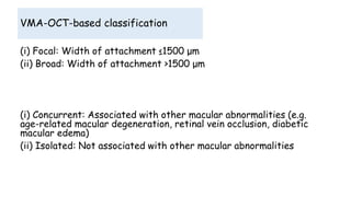 VMA-OCT-based classification
(i) Focal: Width of attachment ≤1500 μm
(ii) Broad: Width of attachment >1500 μm
(i) Concurrent: Associated with other macular abnormalities (e.g.
age-related macular degeneration, retinal vein occlusion, diabetic
macular edema)
(ii) Isolated: Not associated with other macular abnormalities
 