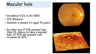 Macular hole
• Incidence 0.3% in 3in 1000
• 12% Bilateral
• Common in women 3:1 aged 70 years
• In other eye if PVD present less
than 1% chance to have a macular
hole. If PVD not present risk
increase by 20%.
 