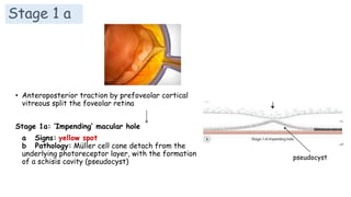 Stage 1 a
• Anteroposterior traction by prefoveolar cortical
vitreous split the foveolar retina
Stage 1a: ‘Impending’ macular hole
a Signs: yellow spot
b Pathology: Müller cell cone detach from the
underlying photoreceptor layer, with the formation
of a schisis cavity (pseudocyst)
pseudocyst
 