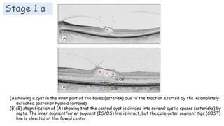 Stage 1 a
(A)showing a cyst in the inner part of the fovea (asterisk) due to the traction exerted by the incompletely
detached posterior hyaloid (arrows).
(B)(B) Magnification of (A) showing that the central cyst is divided into several cystic spaces (asterisks) by
septa. The inner segment/outer segment (IS/OS) line is intact, but the cone outer segment tips (COST)
line is elevated at the foveal center.
 