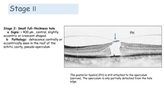 Stage II
Stage 2: Small full-thickness hole
a Signs: < 400 µm , central, slightly
eccentric or crescent-shaped.
b Pathology: dehiscence centrally or
eccentrically seen in the roof of the
schitic cavity, pseudo-operculum
The posterior hyaloid (PH) is still attached to the operculum
(aarrow). The operculum is only partially detached from the hole
edge.
 