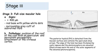 Stage III
Stage 3: Full-size macular hole
a Signs:
- > 400 µm
- red base with yellow-white dots
- surrounding grey cuff of
subretinal fluid
b Pathology: avulsion of the roof
of the cyst with an operculum and
persistent peripapillary
attachment of the vitreous
cortex.
The posterior hyaloid (PH) is detached from the
macular surface and contains the operculum (blue
arrow). The edge of the hole has been thickened by
cystic spaces and the photoreceptors are elevated
(black arrows mark the end of the outer segments of
the elevated photoreceptors).
 