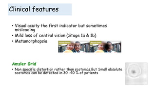 Clinical features
• Visual acuity the first indicator but sometimes
misleading
• Mild loss of central vision (Stage 1a & 1b)
• Metamorphopsia
Amsler Grid
• Non specific distortion rather than scotomas.But Small absolute
scotomas can be detected in 30 -40 % of patients
 