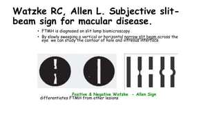Watzke RC, Allen L. Subjective slit-
beam sign for macular disease.
• FTMH is diagnosed on slit lamp biomicroscopy
• By slowly sweeping a vertical or horizontal narrow slit beam across the
eye we can study the contour of hole and vitreous interface
differentiates FTMH from other lesions
Positive & Negative Watzke - Allen Sign
 