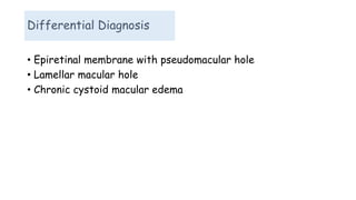 Differential Diagnosis
• Epiretinal membrane with pseudomacular hole
• Lamellar macular hole
• Chronic cystoid macular edema
 