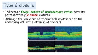 Type 2 closure
• Indicates a foveal defect of neurosensory retina persists
postoperatively(w shape closure)
• Although the whole rim of macular hole is attached to the
underlying RPE with flattening of the cuff
 