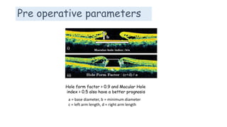 Pre operative parameters
Hole form factor > 0.9 and Macular Hole
index > 0.5 also have a better prognosis
a = base diameter, b = minimum diameter
c = left arm length, d = right arm length
 