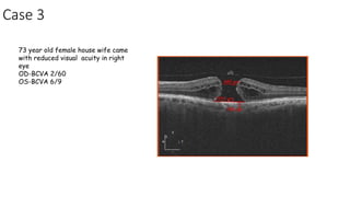 Case 3
73 year old female house wife came
with reduced visual acuity in right
eye
OD-BCVA 2/60
OS-BCVA 6/9
 