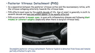 • Posterior Vitreous Detachment (PVD)
• Is a separation between the posterior vitreous cortex and the neurosensory retina, with
the vitreous collapsing anteriorly towards the vitreous base.
• PVD affects most eyes by the eighth decade of life. Age at onset is generally in sixth to
seventh decade and men and women appear to be equally affected.
• PVD occurs earlier in myopic eyes, in eyes with inflammatory disease and following blunt
trauma or cataract surgery (especially when there is surgical vitreous loss).
Incomplete posterior vitreous detachment. Posterior hyaloid is detached from fovea and remains
partially attached to optic disc.
 
