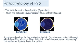Pathophysiology of PVD
• The initial event is liquefaction (Synchisis)
• Then the collapse (Syneresis) of the central vitreous.
Synchysis Syneresis
A rupture develops in the posterior hyaloid (or vitreous cortex) through
which liquefied vitreous flows into the retrovitreous space, separating
the posterior hyaloid from the retina.
 