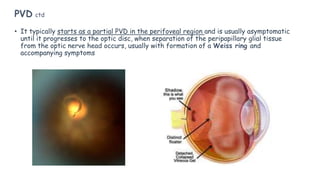 • It typically starts as a partial PVD in the perifoveal region and is usually asymptomatic
until it progresses to the optic disc, when separation of the peripapillary glial tissue
from the optic nerve head occurs, usually with formation of a Weiss ring and
accompanying symptoms
PVD ctd
 