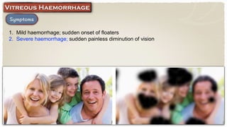 1. Mild haemorrhage; sudden onset of floaters
2. Severe haemorrhage; sudden painless diminution of vision
 