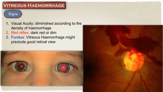 1. Visual Acuity; diminished according to the
density of haemorrhage
2. Red reflex: dark red or dim
3. Fundus: Vitreous Haemorrhage might
preclude good retinal view
 