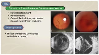 • Retinal Detachment
• Retinal edema
• Central Retinal Artery occlusion
• Central Retinal Vein occlusion
• B scan Ultrasound (to exclude
retinal detachment)
 