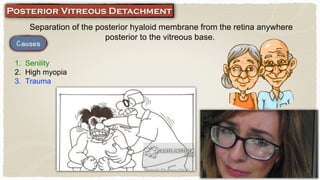Separation of the posterior hyaloid membrane from the retina anywhere
posterior to the vitreous base.
1. Senility
2. High myopia
3. Trauma
 