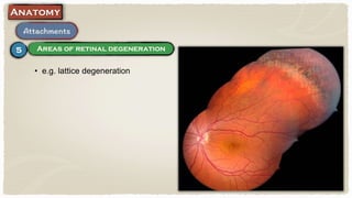 • e.g. lattice degeneration
 
