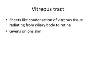 Vitreous tract
• Sheets like condensation of vitreous tissue
radiating from ciliary body to retina
• Givens onions skin
 