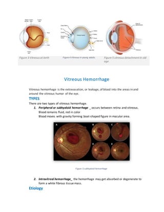 Retinal Hemorrhage Boat Retinal Hemorrhage Boat
