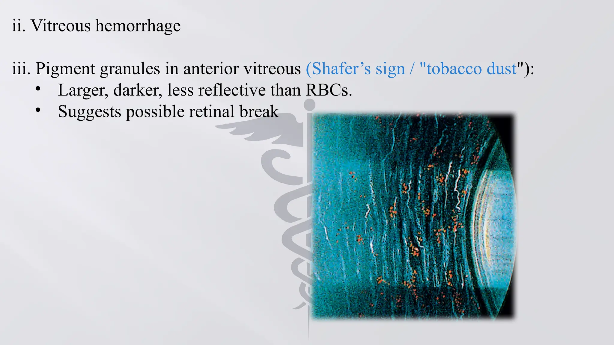 tobacco dust in anterior vitreous PVD and retinal detachment, an optometric approach - part 2 Shafer's Sign: When Pigment