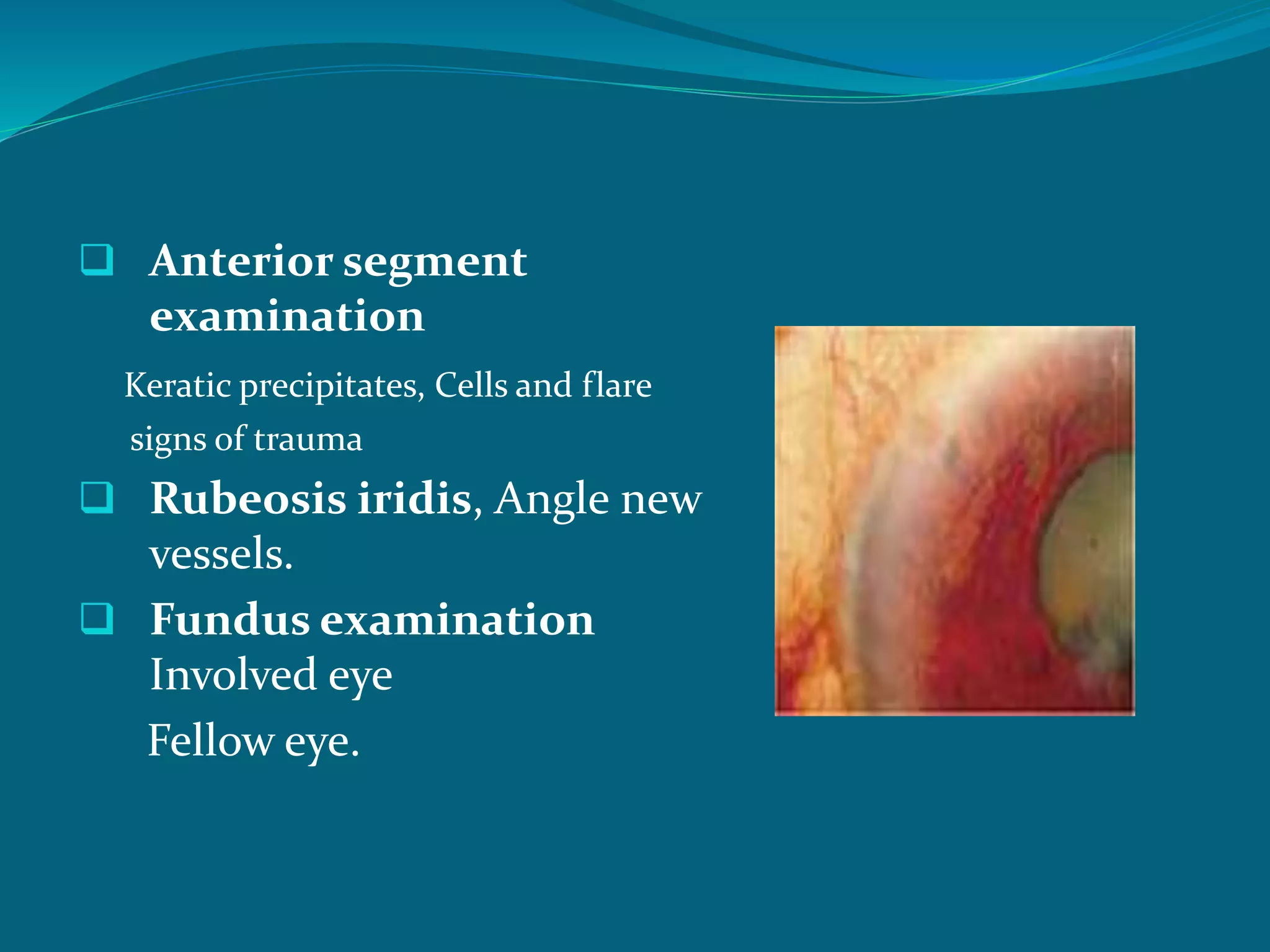 Subtle Rubeosis Vitreous hemorrhage | PPTX