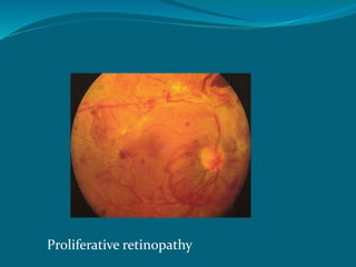 Proliferative retinopathy
 