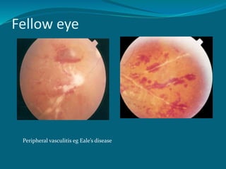Fellow eye
Peripheral vasculitis eg Eale’s disease
 