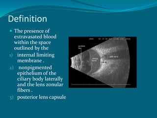 Definition
 The presence of
extravasated blood
within the space
outlined by the
1) internal limiting
membrane .
2) nonpigmented
epithelium of the
ciliary body laterally
and the lens zonular
fibers .
3) posterior lens capsule
 