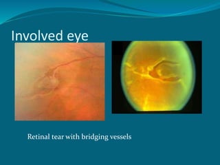 Involved eye
Retinal tear with bridging vessels
 