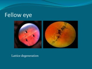 Fellow eye
Lattice degeneration
 