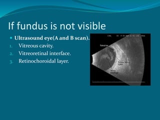If fundus is not visible
 Ultrasound eye(A and B scan).
1. Vitreous cavity.
2. Vitreoretinal interface.
3. Retinochoroidal layer.
 