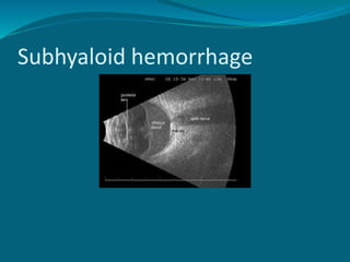 Subhyaloid hemorrhage
 