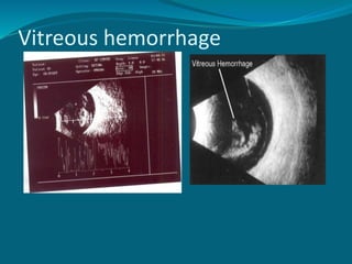 Vitreous hemorrhage
 