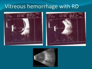 Vitreous hemorrhage with RD
 