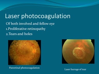 Laser photocoagulation
Of both involved and fellow eye
1.Proliferative retinopathy
2.Tears and holes
Panretinal photocoagulation
Laser barrage of tear
 