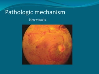 Pathologic mechanism
New vessels.
 