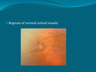  Rupture of normal retinal vessels.
 