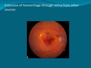 Extension of hemorrhage through retina from other
sources
 
