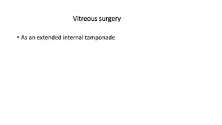 Vitreous surgery
• As an extended internal tamponade
 