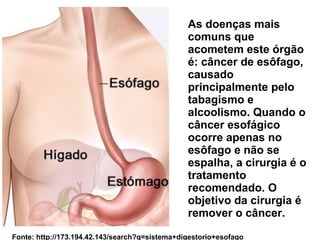 As doenças mais 
comuns que 
acometem este órgão 
é: câncer de esôfago, 
causado 
principalmente pelo 
tabagismo e 
alcoolismo. Quando o 
câncer esofágico 
ocorre apenas no 
esôfago e não se 
espalha, a cirurgia é o 
tratamento 
recomendado. O 
objetivo da cirurgia é 
remover o câncer. 
Fonte: http://173.194.42.143/search?q=sistema+digestorio+esofago 
 