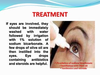 TREATMENT
If eyes are involved, they
   should be immediately
   washed     with     water
   followed by irrigation
   with 1% solution of
   sodium bicarbonate. A
   few drops of olive oil are
   then instilled into the
   eyes.     Eye      drops
   containing    antibiotics
   and steroids are helpful.    1% solution of sodium bicarbonate
                                    Instillation with Olive oil
                                     Antibiotics and steroids
 
