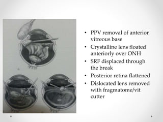 • PPV removal of anterior
vitreous base
• Crystalline lens floated
anteriorly over ONH
• SRF displaced through
the break
• Posterior retina flattened
• Dislocated lens removed
with fragmatome/vit
cutter
 