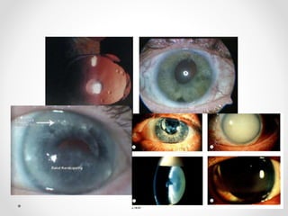 Vitreous substitutes
