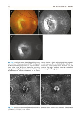 Disciform Macula Viva and Objective Structured Clinical Examination (OSCE) Exams in ...