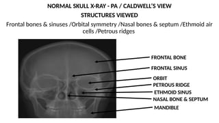 Petrous Ridge Positioning Chart X-ray Reading Guide for UG MBBS students VIVA X-RAYS.pptx