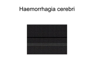 Haemorrhagia cerebri

 