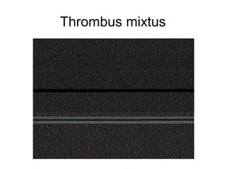 Thrombus mixtus

 