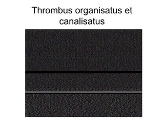 Thrombus organisatus et
canalisatus

 