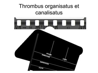 Thrombus organisatus et
canalisatus

 