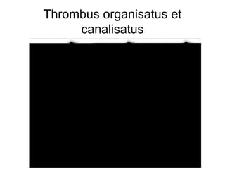 Thrombus organisatus et
canalisatus

 